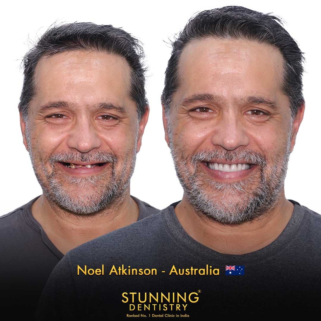 All-on-4, both arches · International patient