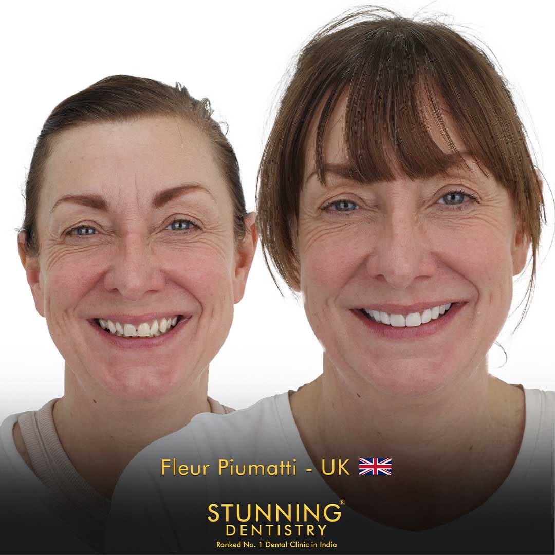 Cosmetic restoration