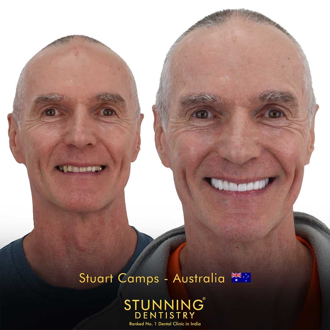 Smile restoration · International patient