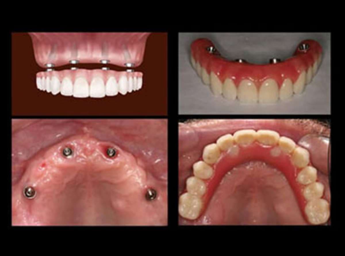All-on-4 Implants