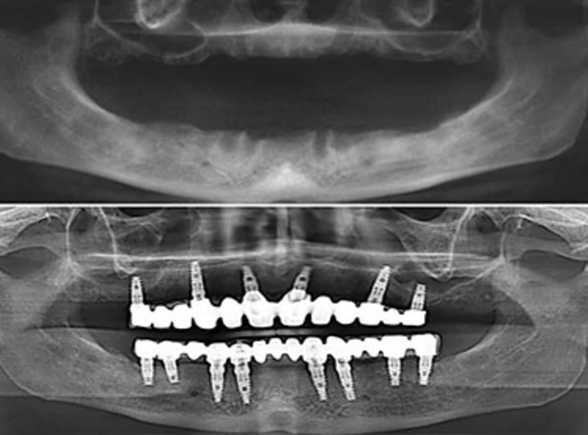 All-on-6/8 Implants