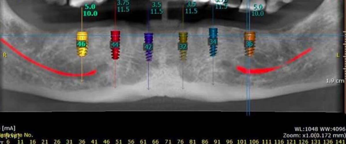 CBCT 3D Imaging