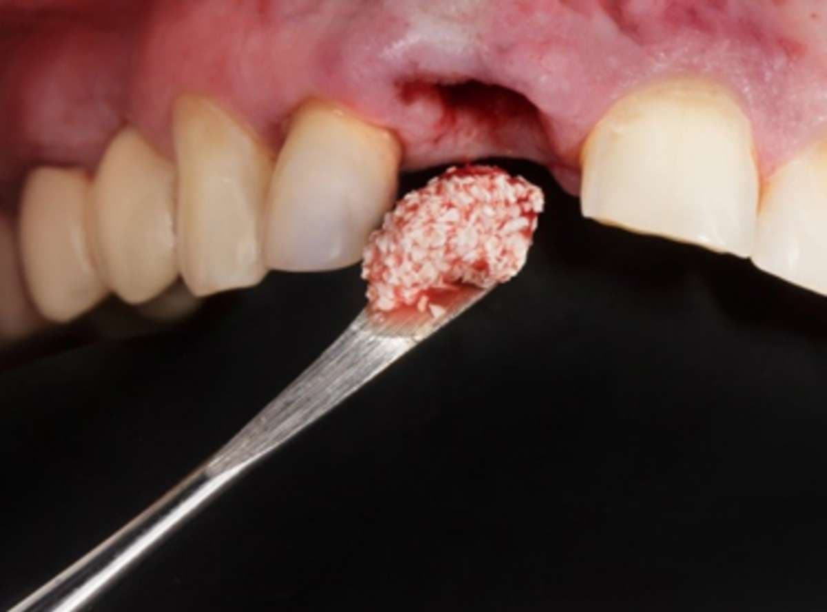 Infographic: jawbone with denture vs implant over 5 years.