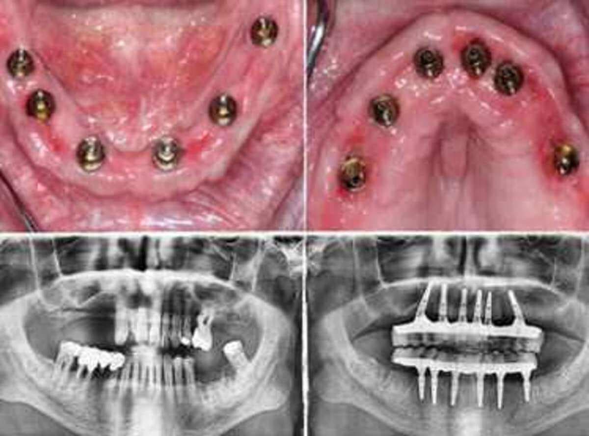 Multiple Implants