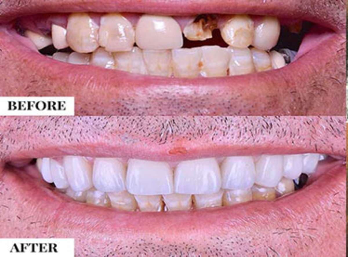 Single Implant