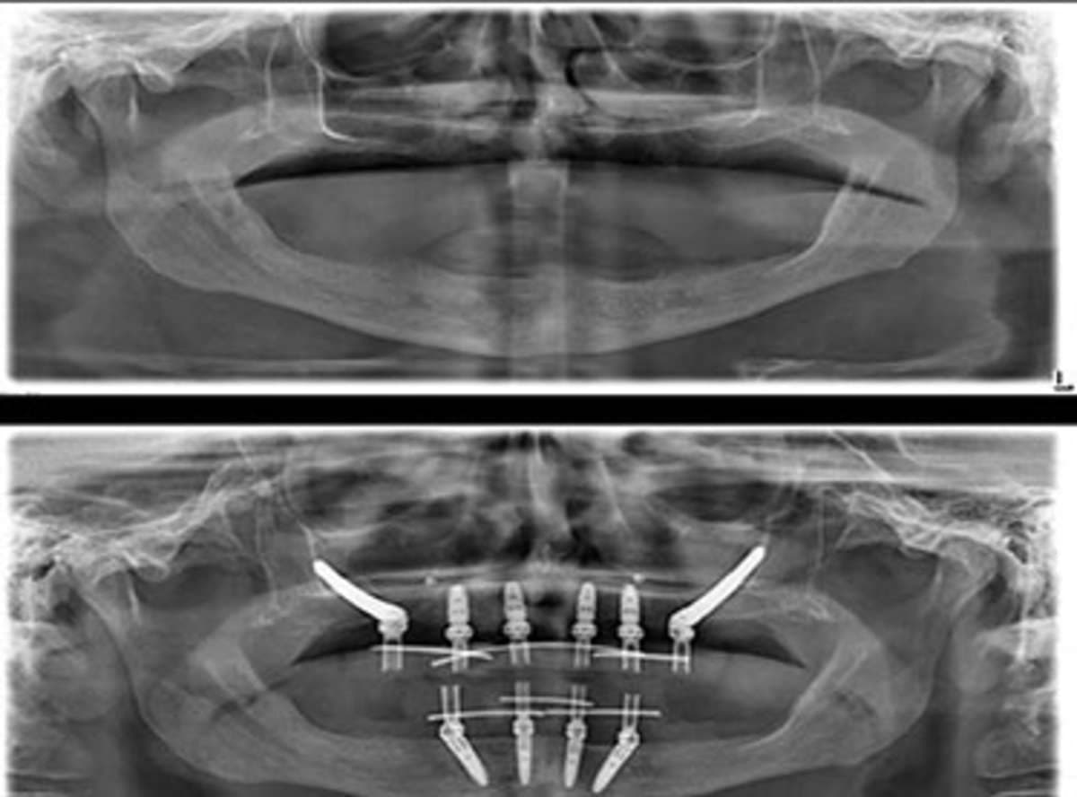 Zygomatic Implants